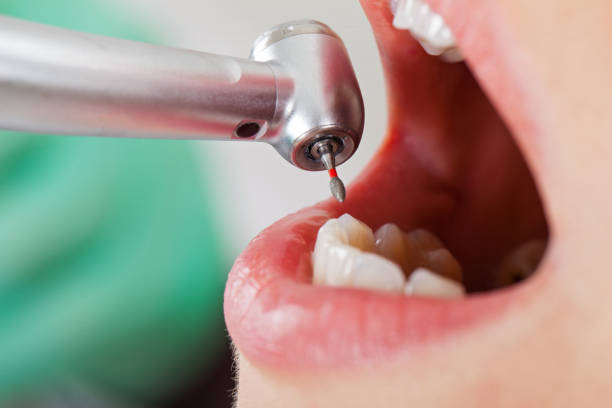 Best Emergency Tooth Extraction in Bellevue, WA